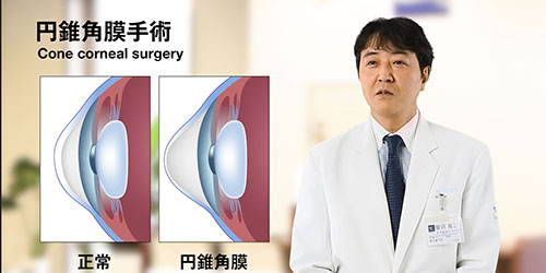 円錐角膜手術